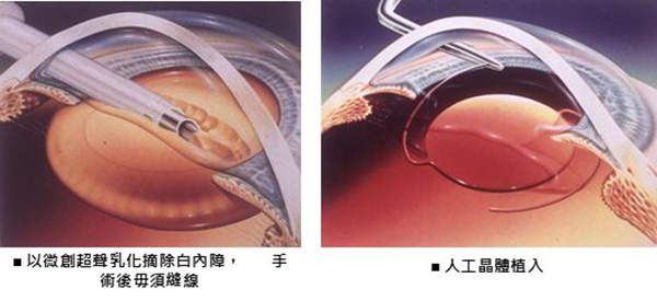 白內(nèi)障,?，斎鹨曆劭?上海眼科醫(yī)院