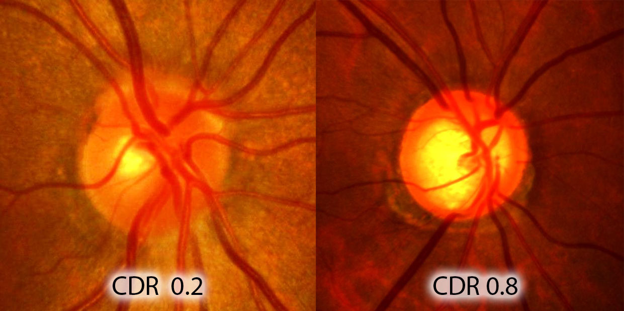 青光眼,?，斎鹨曆劭?上海眼科醫(yī)院