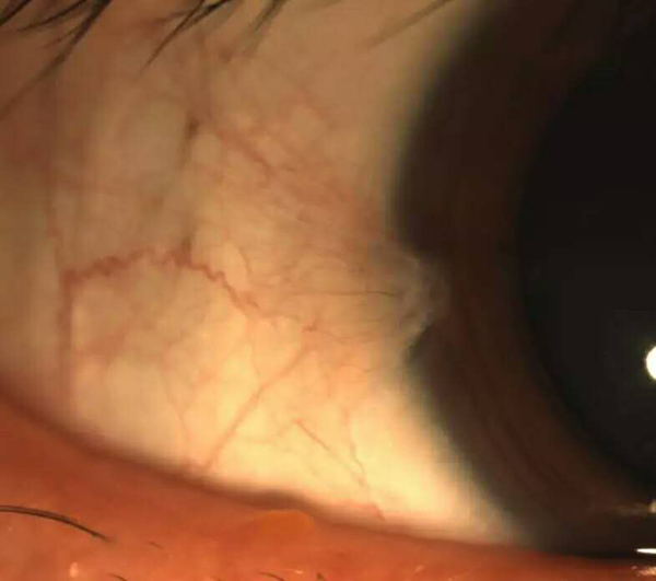 眼表眼角膜,?，斎鹨曆劭?上海眼科醫(yī)院