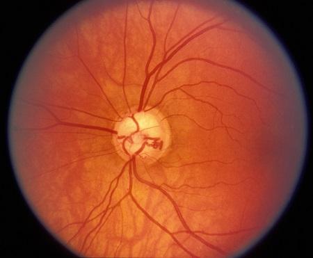 青光眼,?，斎鹨曆劭?上海眼科醫(yī)院