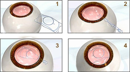屈光矯視,?，斎鹨曆劭?上海眼科醫(yī)院