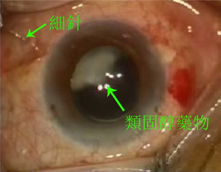 白內(nèi)障,希瑪瑞視眼科,上海眼科醫(yī)院