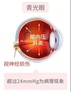 青光眼,?，斎鹨曆劭?上海眼科醫(yī)院