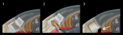 青光眼,希瑪瑞視眼科,上海眼科醫(yī)院