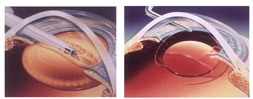 青光眼,?，斎鹨曆劭?上海眼科醫(yī)院