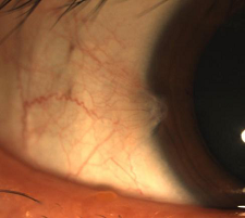 眼表眼角膜,希瑪瑞視眼科,上海眼科醫(yī)院