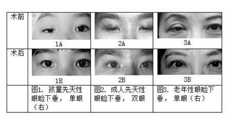 眼眶病,?，斎鹨曆劭?上海眼科醫(yī)院