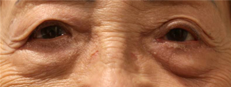 眼眶病,希瑪瑞視眼科,上海眼科醫(yī)院