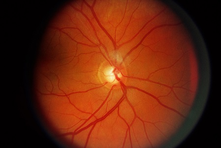 青光眼,?，斎鹨曆劭?上海眼科醫(yī)院