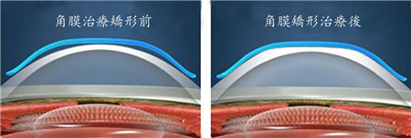 屈光矯視,?，斎鹨曆劭?上海眼科醫(yī)院