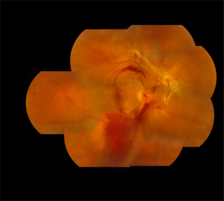 玻璃體視網(wǎng)膜,?，斎鹨曆劭?上海眼科醫(yī)院