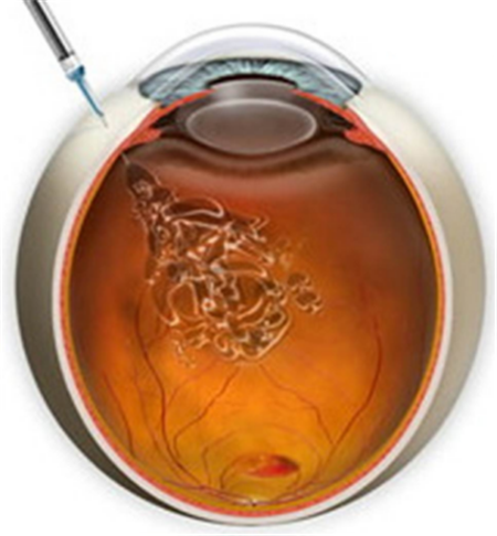 玻璃體視網(wǎng)膜,?，斎鹨曆劭?上海眼科醫(yī)院