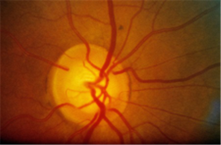 青光眼,?，斎鹨曆劭?上海眼科醫(yī)院