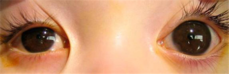 青光眼,?，斎鹨曆劭?上海眼科醫(yī)院