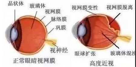 玻璃體視網(wǎng)膜,?，斎鹨曆劭?上海眼科醫(yī)院