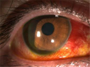 玻璃體視網(wǎng)膜,希瑪瑞視眼科,上海眼科醫(yī)院