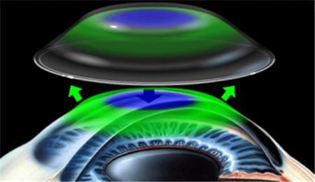 屈光矯視,?，斎鹨曆劭?上海眼科醫(yī)院