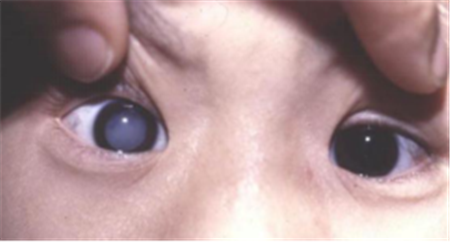 白內(nèi)障,?，斎鹨曆劭?上海眼科醫(yī)院