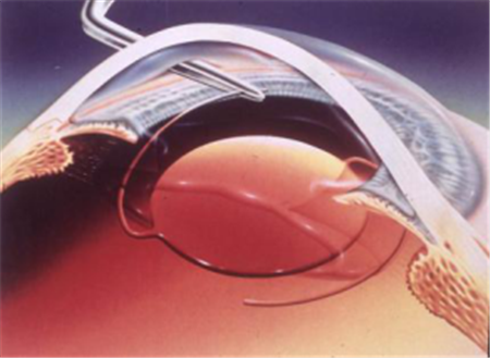 白內(nèi)障,?，斎鹨曆劭?上海眼科醫(yī)院