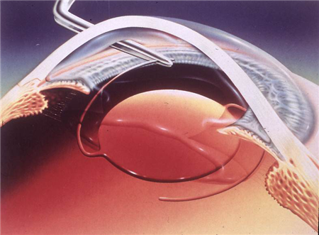 白內(nèi)障,?，斎鹨曆劭?上海眼科醫(yī)院