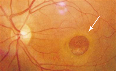 玻璃體視網(wǎng)膜,?，斎鹨曆劭?上海眼科醫(yī)院