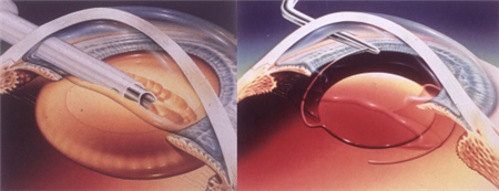 白內(nèi)障,?，斎鹨曆劭?上海眼科醫(yī)院