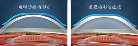 白內(nèi)障,?，斎鹨曆劭?上海眼科醫(yī)院