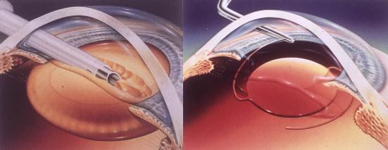 白內(nèi)障,?，斎鹨曆劭?上海眼科醫(yī)院