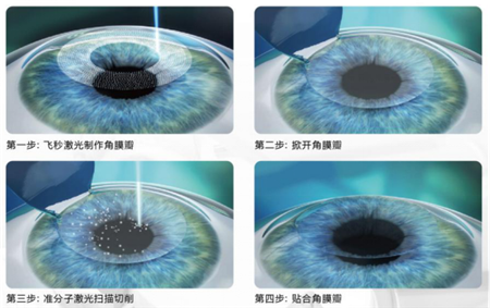 屈光矯視,?，斎鹨曆劭?上海眼科醫(yī)院