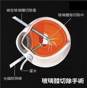 玻璃體視網(wǎng)膜,?，斎鹨曆劭?上海眼科醫(yī)院