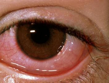 眼表眼角膜,?，斎鹨曆劭?上海眼科醫(yī)院