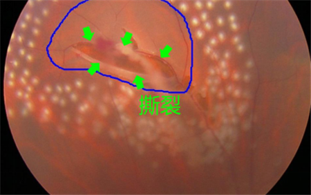 玻璃體視網(wǎng)膜,?，斎鹨曆劭?上海眼科醫(yī)院