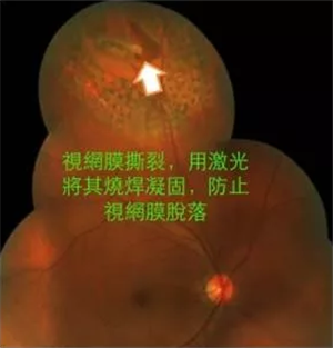 玻璃體視網(wǎng)膜,?，斎鹨曆劭?上海眼科醫(yī)院