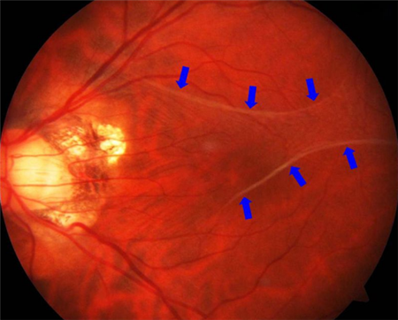 玻璃體視網(wǎng)膜,希瑪瑞視眼科,上海眼科醫(yī)院