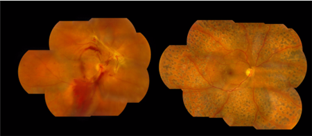 玻璃體視網(wǎng)膜,?，斎鹨曆劭?上海眼科醫(yī)院