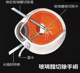 玻璃體視網(wǎng)膜,希瑪瑞視眼科,上海眼科醫(yī)院