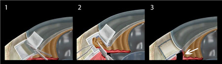 青光眼,?，斎鹨曆劭?上海眼科醫(yī)院