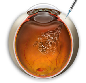 玻璃體視網(wǎng)膜,?，斎鹨曆劭?上海眼科醫(yī)院