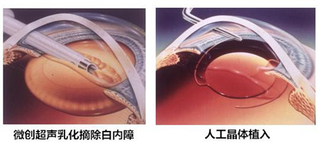 白內(nèi)障,希瑪瑞視眼科,上海眼科醫(yī)院