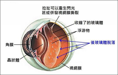 玻璃體視網(wǎng)膜,?，斎鹨曆劭?上海眼科醫(yī)院