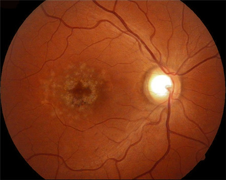 玻璃體視網(wǎng)膜,希瑪瑞視眼科,上海眼科醫(yī)院