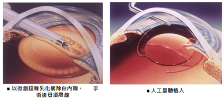 白內障,?，斎鹨曆劭?上海眼科醫(yī)院