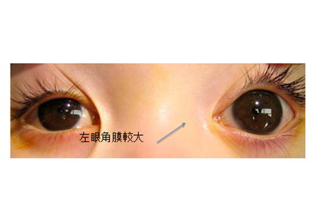 青光眼,?，斎鹨曆劭?上海眼科醫(yī)院