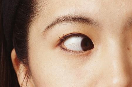 小兒眼病,?，斎鹨曆劭?上海眼科醫(yī)院