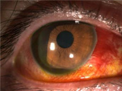 眼表眼角膜,?，斎鹨曆劭?上海眼科醫(yī)院