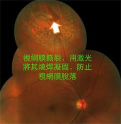 玻璃體視網(wǎng)膜,?，斎鹨曆劭?上海眼科醫(yī)院