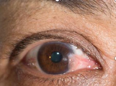 眼表眼角膜,?，斎鹨曆劭?上海眼科醫(yī)院