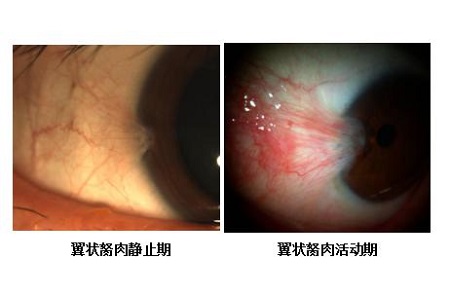 眼表眼角膜,?，斎鹨曆劭?上海眼科醫(yī)院