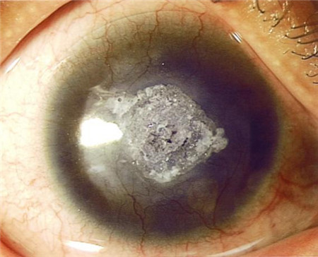 眼表眼角膜,?，斎鹨曆劭?上海眼科醫(yī)院