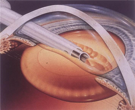 白內(nèi)障,?，斎鹨曆劭?上海眼科醫(yī)院